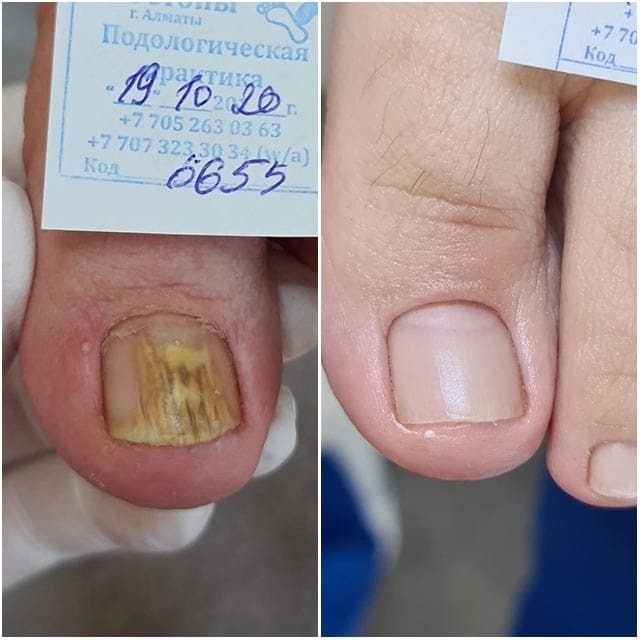 Результат лечения грибка ногтей, пример №2