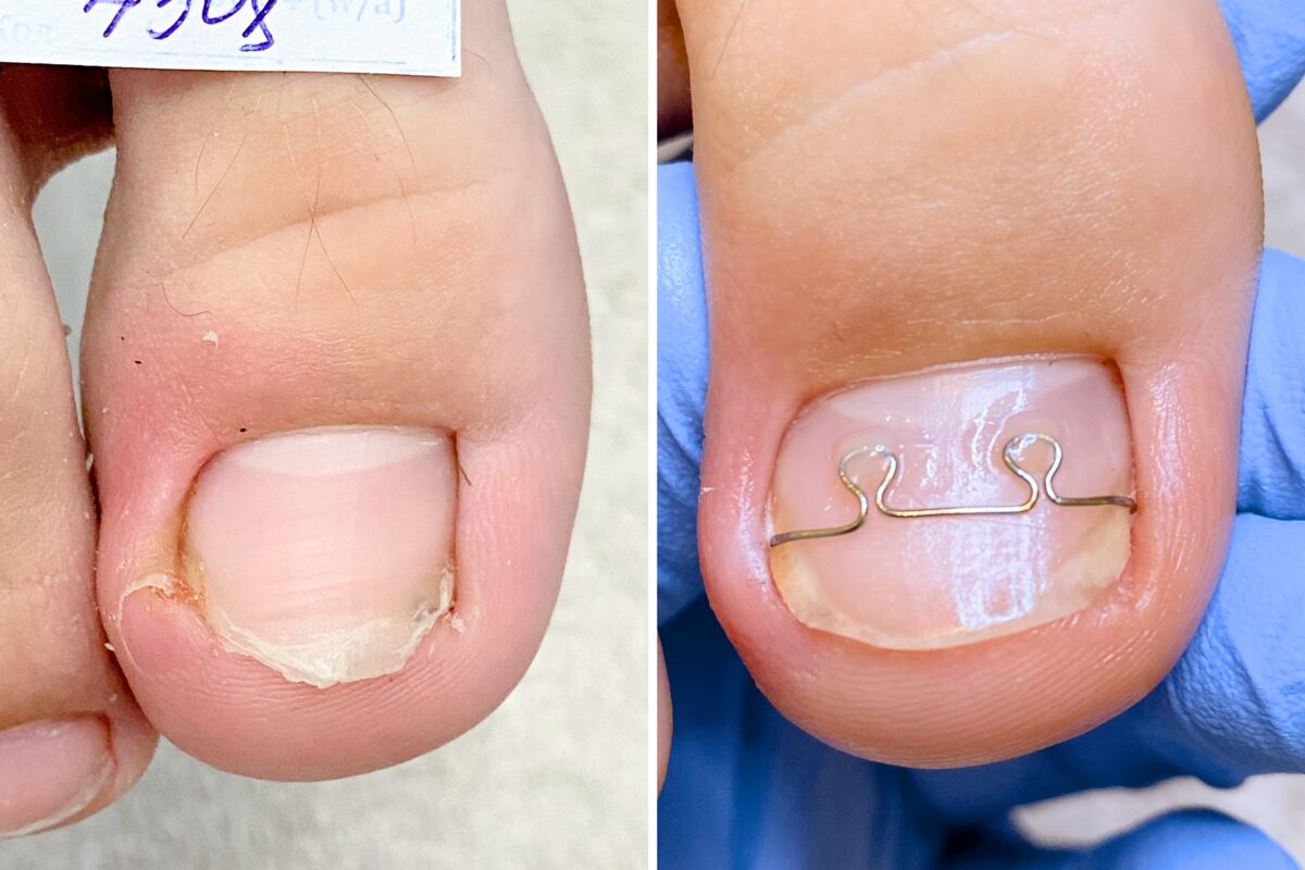 На первом фото ногть скручен, а на втором он прямой