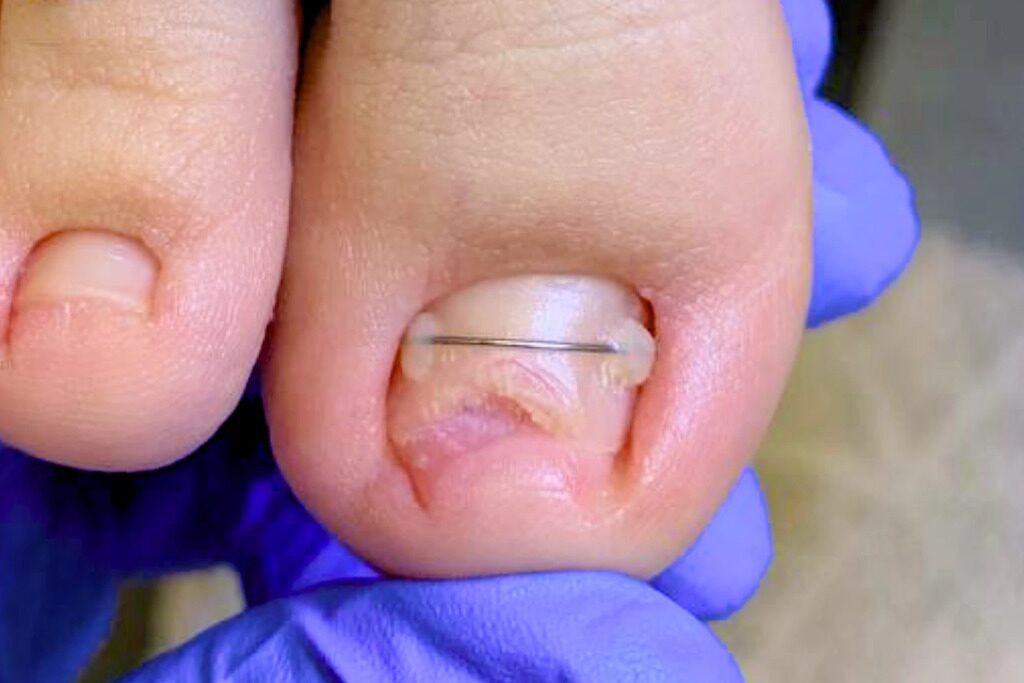 Скрученный ноготь с титановой нитью