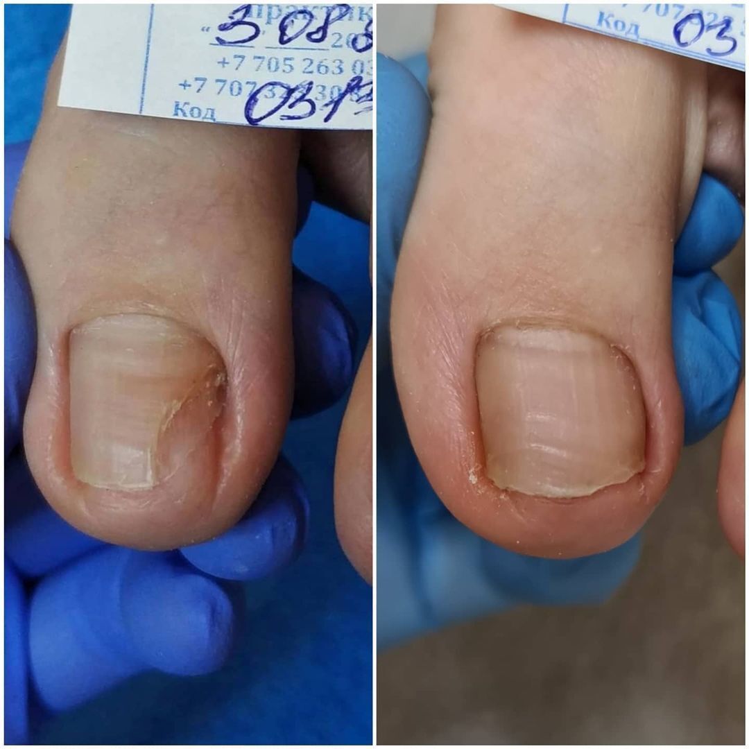 Лечение скрученного ногтя