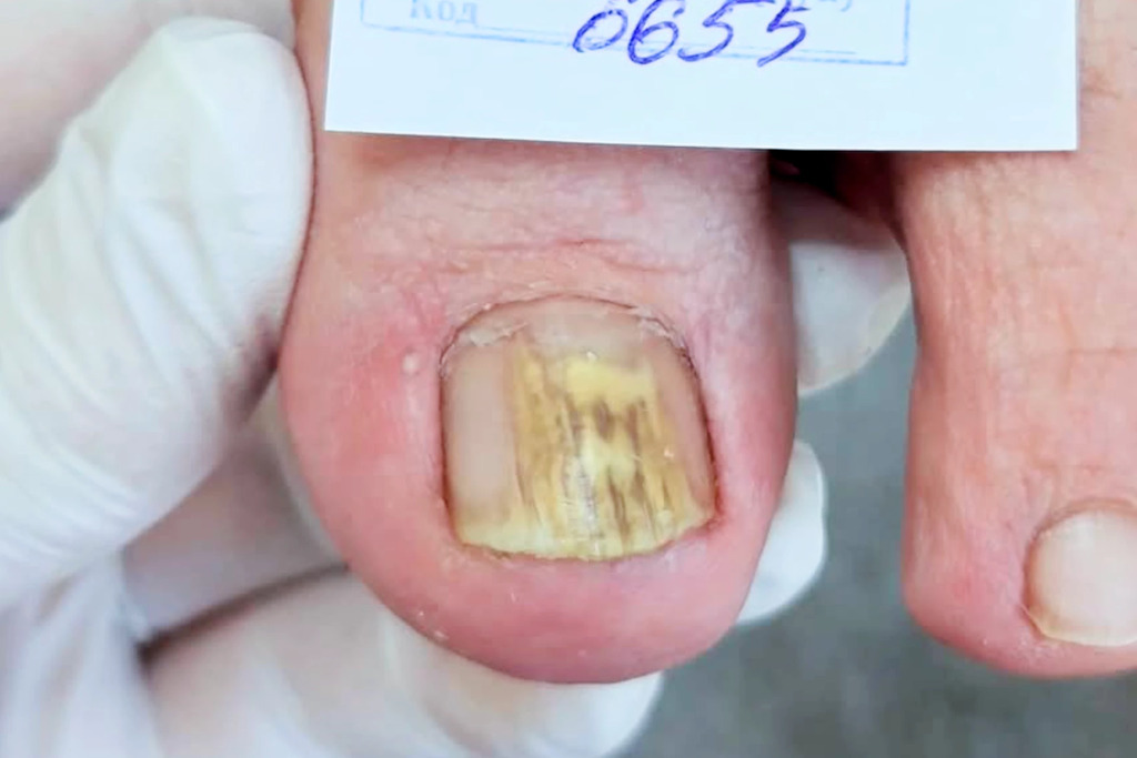 линии показывают, что ортопедическая стелька подходит стопе