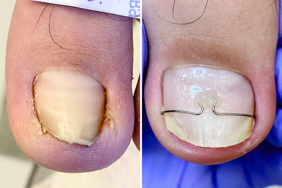 На первом фото ногть скручен, а на втором он прямой