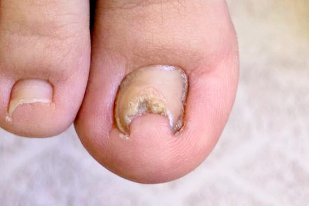 Скрученный ноготь