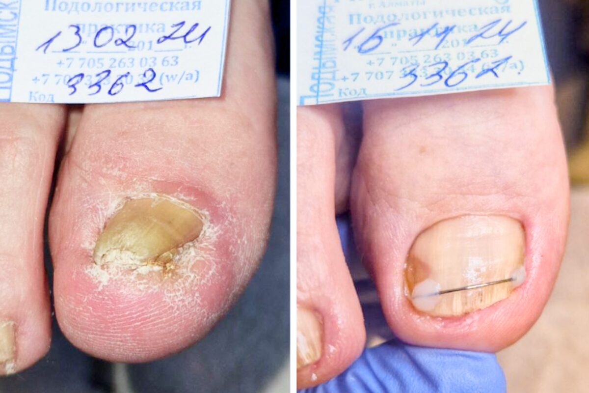 На первом фото ногть скручен, а на втором он прямой