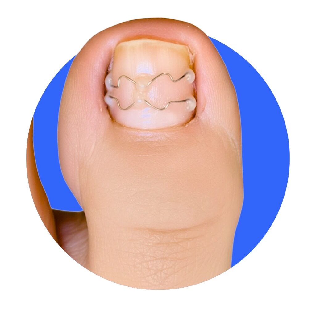 Ноготь с корректирующей системой UniBrace®