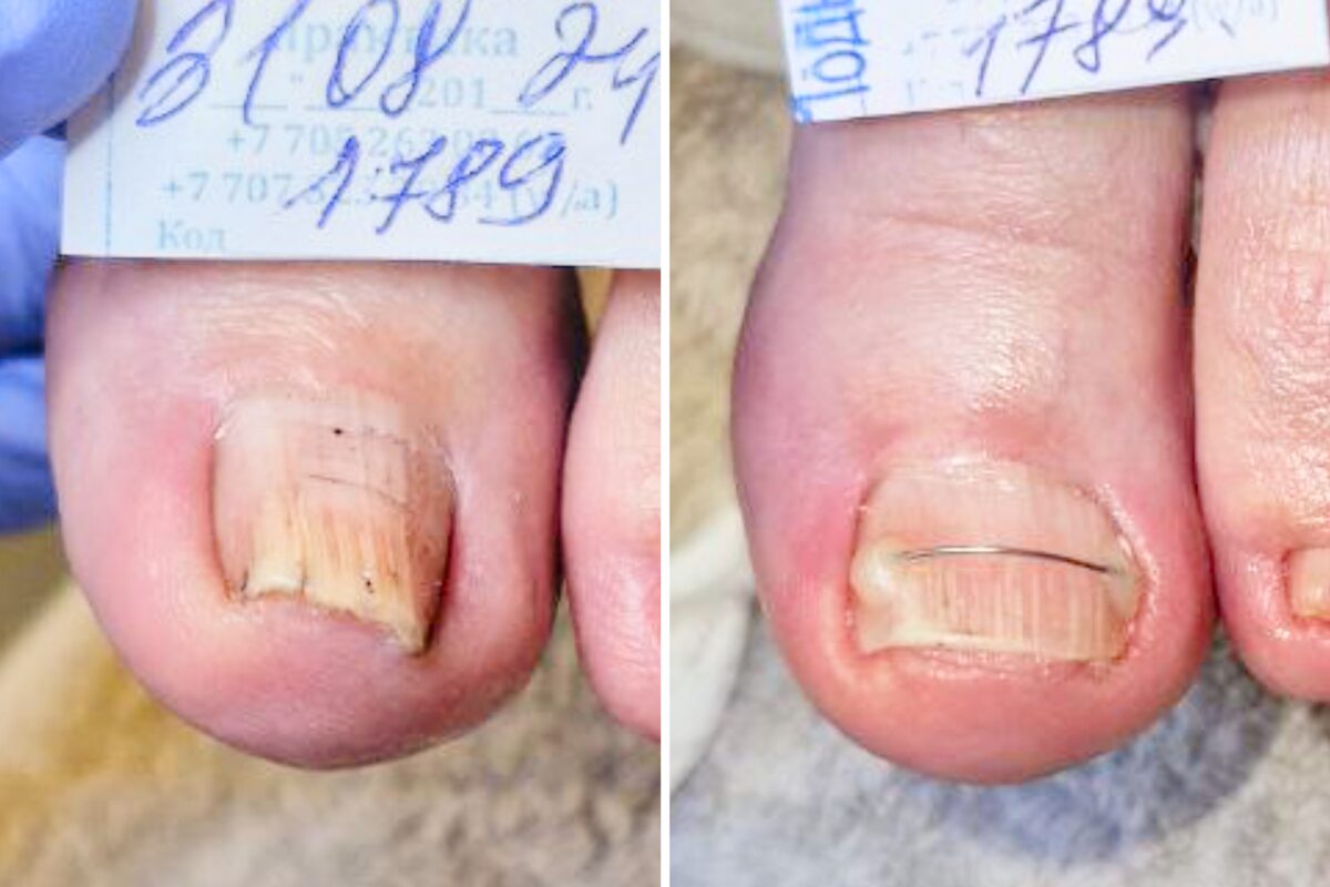 На первом фото ногть скручен, а на втором он прямой