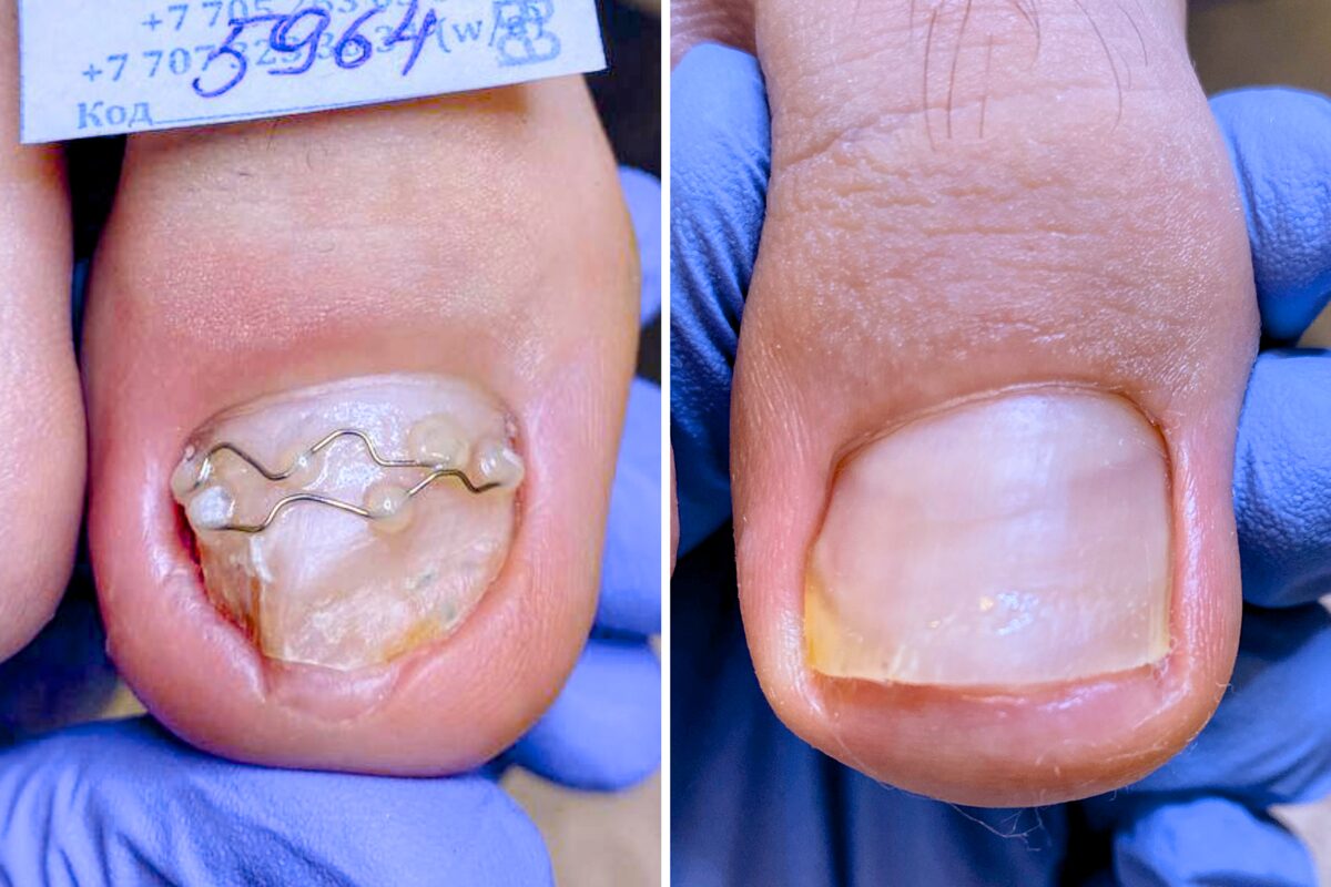 На первом фото ногть скручен, а на втором он прямой